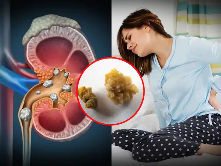 Kidney stone Symptoms