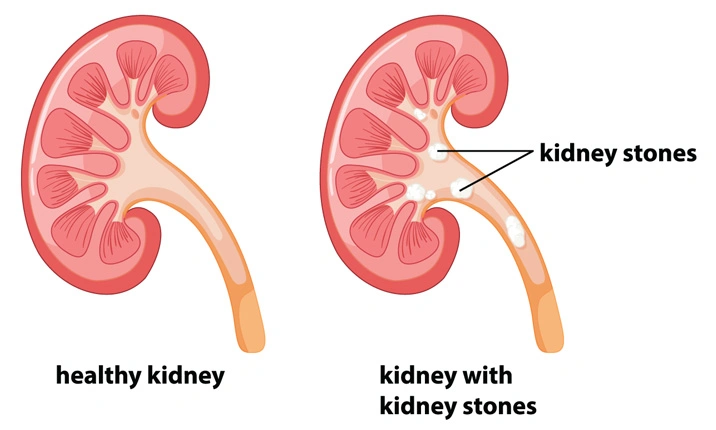 Ways to prevent kidney stones