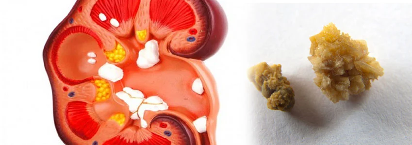 Metabolic diseases increases the recurrence of Kidney stone