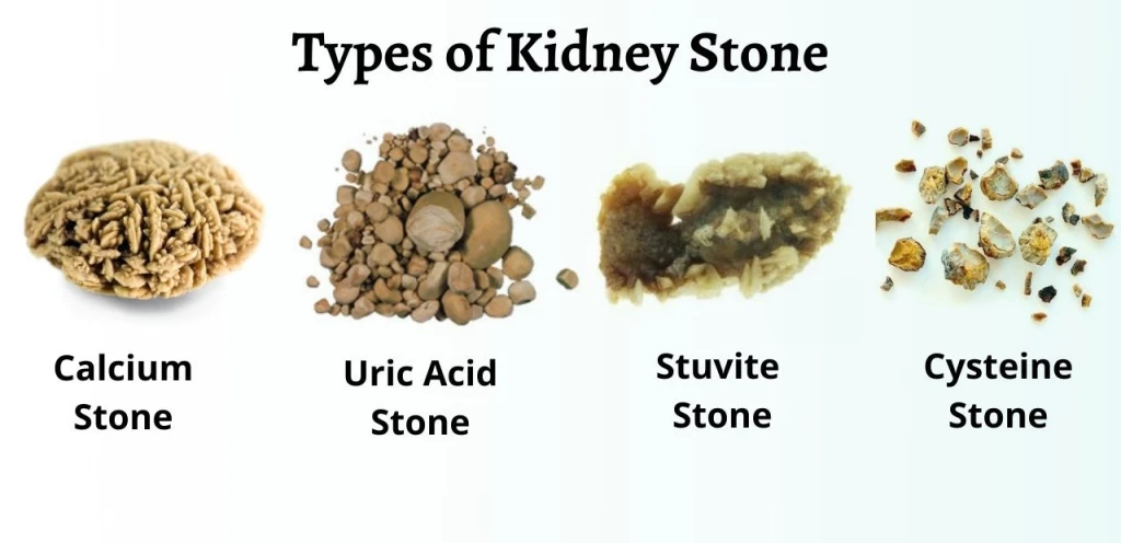 Type of Kidney Stones