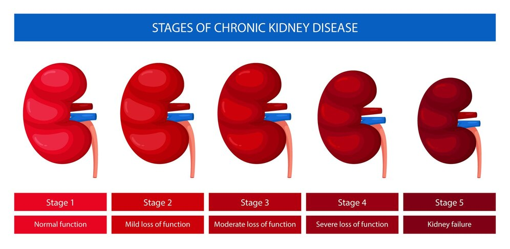 Stages of chronic kidney disease- gallbladder stones