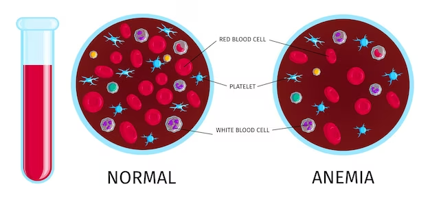 Anemia