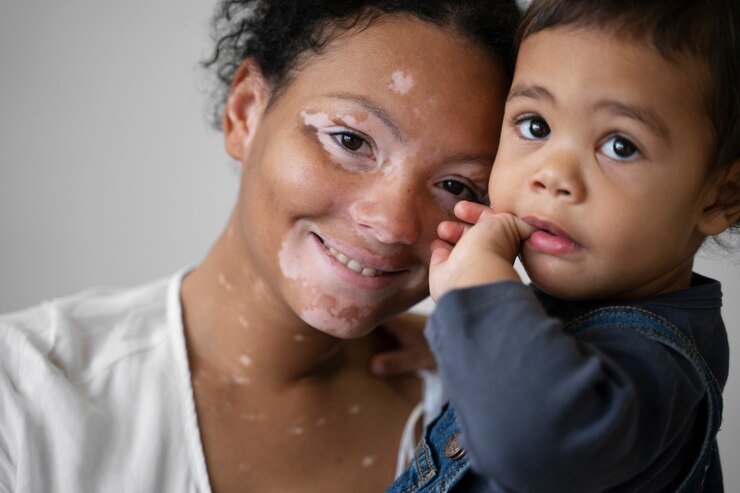 Vitiligo is not directly inherited like some genetic condition