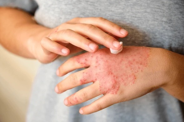 Eczema (Atopic Dermatitis)
