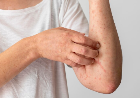 Contact Dermatitis