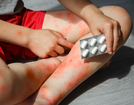 Drug Rashes