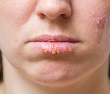 Shingles (Herpes Zoster)