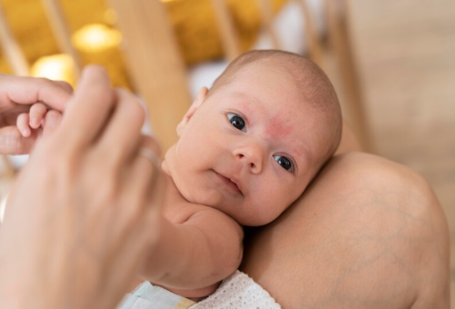 Heat Rashes (Miliaria)