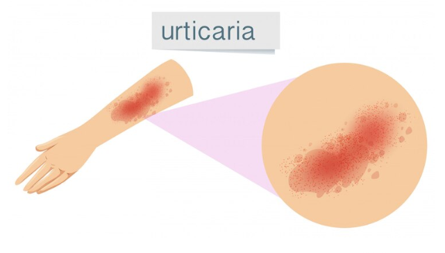 Hives (Urticaria)