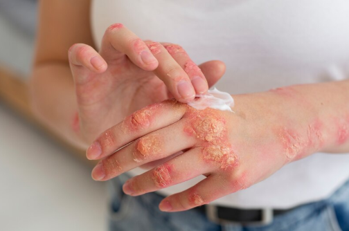 Psoriasis