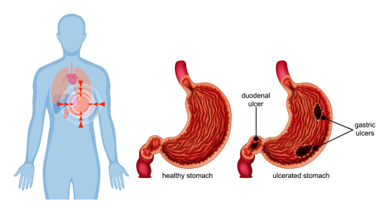 Peptic ulcers